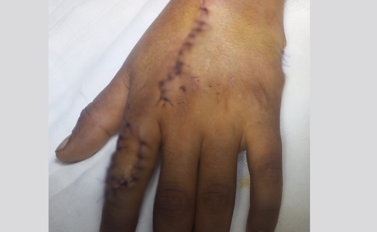 Cirugía de alta especialidad en mano con el Dr. Humberto Sandoval