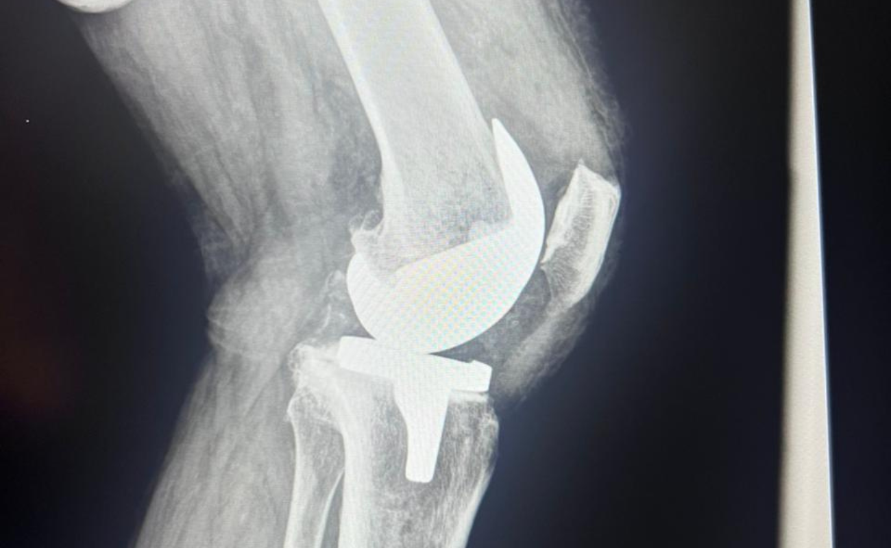 Colocación de prótesis de cadera y rodilla: Procedimiento y beneficios