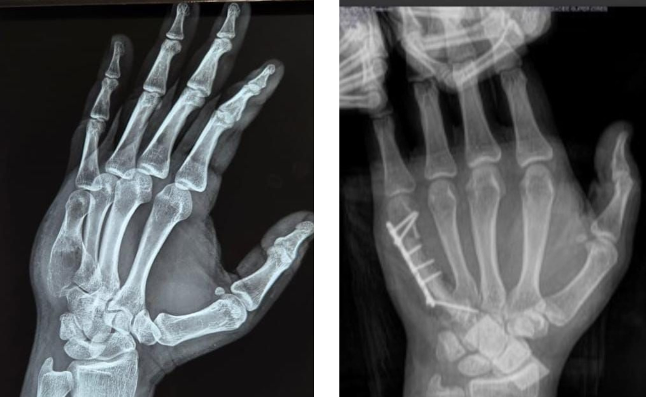 Tratamiento de tumores en la mano con el Dr. Humberto Sandoval