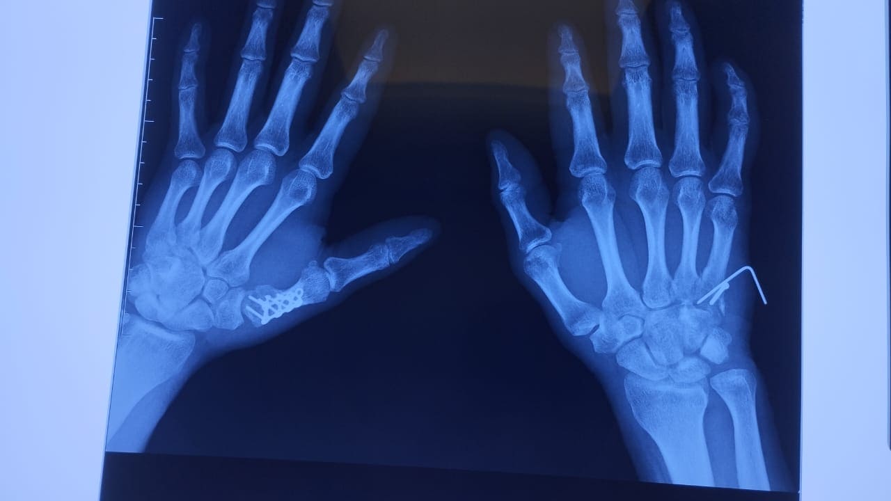 Tratamiento integral de fracturas con el Dr. Humberto Sandoval